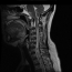 Cervical Spine MRI